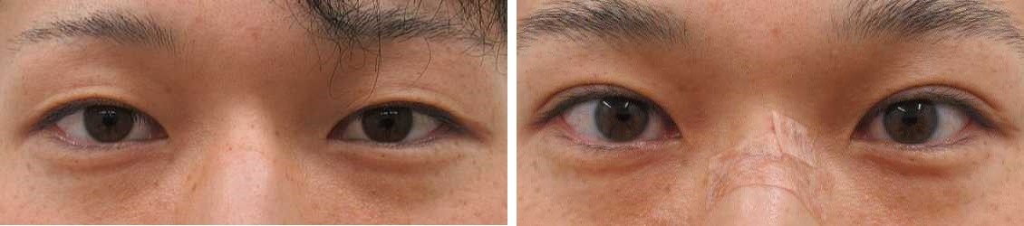 腫れにくい埋没法【コスメリングプロ】