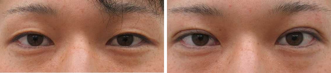 クイックコスメリングの症例写真 施術前後 直後