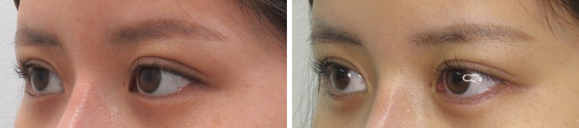 グラマラスライン(タレ目形成)の症例写真 施術前後 1ヵ月