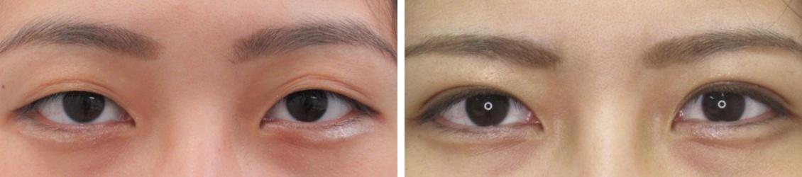 大人気の1dayナチュラルデザインオプティマル（埋没法）でナチュラルな二重に