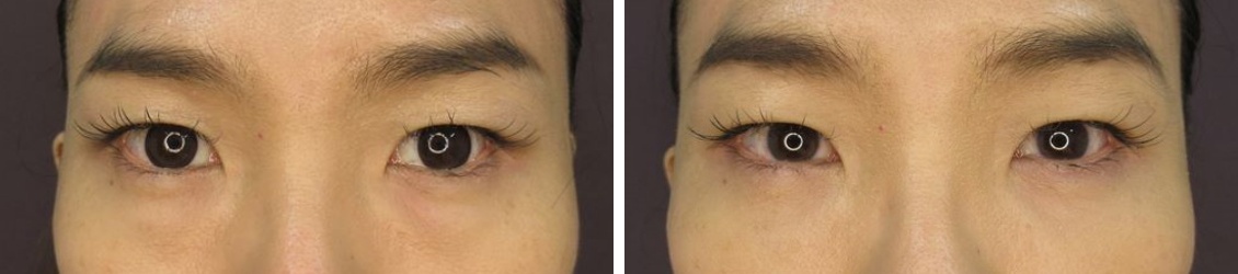 下眼瞼脱脂術でスッキリしたお目元に。