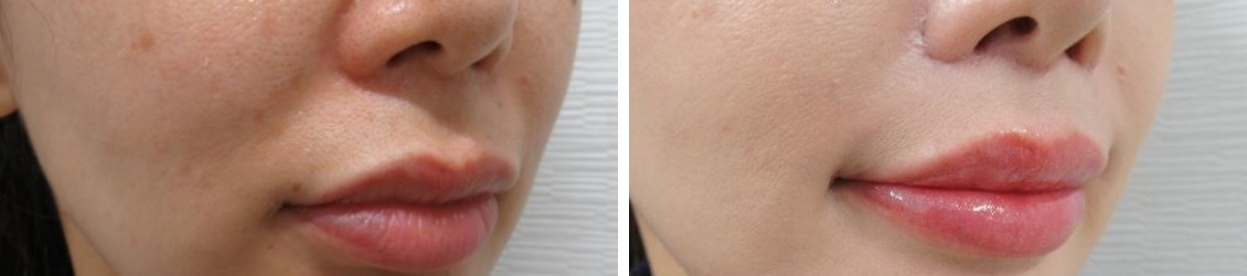 人中短縮術(リップリフト)・外側人中短縮術/口角挙上・リフト(マイクロ切開法・内側法/口内法)の症例写真 施術前後