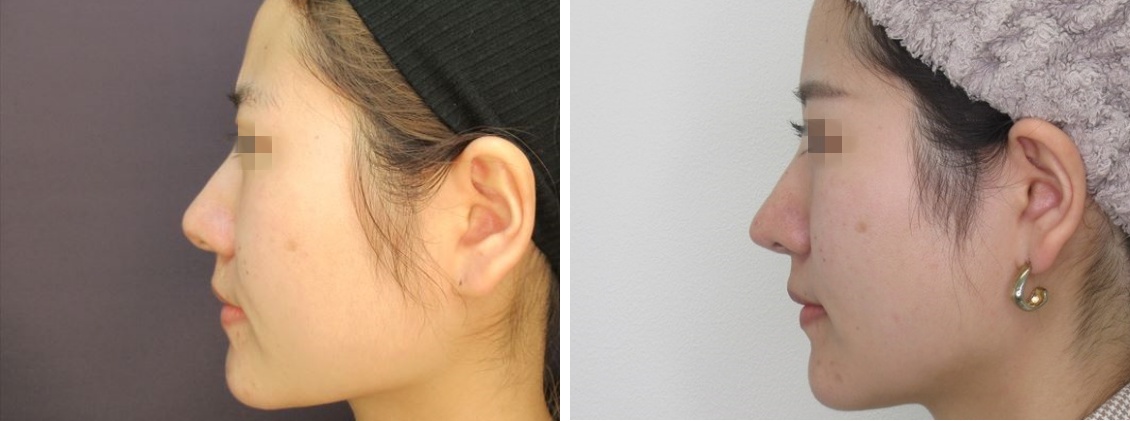 鼻尖４Dノーズ、鼻尖縮小術でスッキリとしたお鼻に