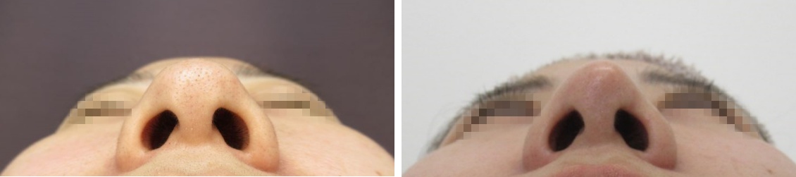 鼻尖4Dノーズ/鼻尖形成・鼻尖縮小/バッカルファット除去の症例写真 施術前後 1カ月後