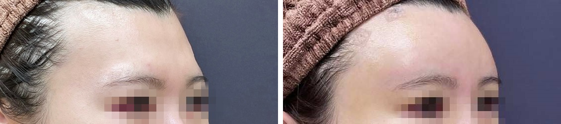 女性らしさをより強く印象づける丸いオデコ