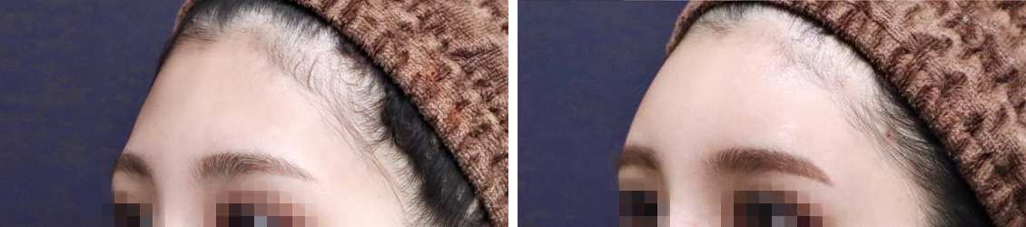 コンデンスリッチフェイス（脂肪注入）で、撫でたくなる愛らしいおでこに