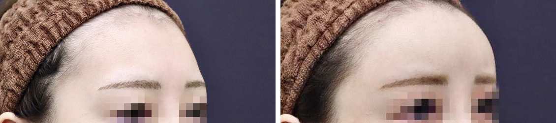 最大限に丸く、オルチャンデコMAX！