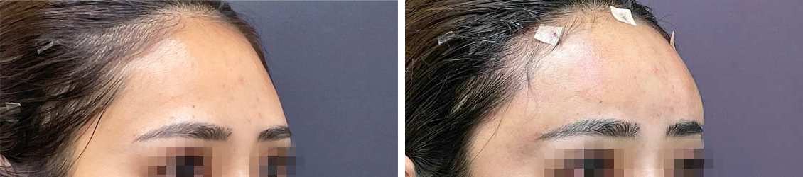 綺麗なオデコをより綺麗に魅せる、オルチャンデコ