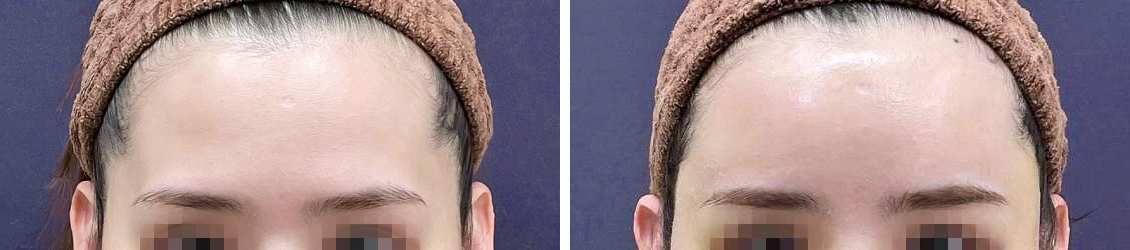 コンデンスリッチフェイス（脂肪注入）で、おでこ〜こめかみにかけて滑らかオルチャンデコ