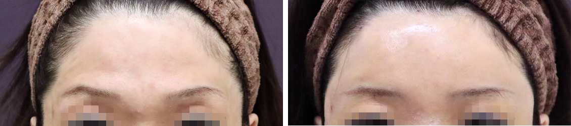 コンデンスリッチフェイス（脂肪注入）でエイジングケア