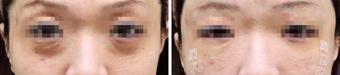 顔の脂肪注入(コンデンスリッチフェイス)/下眼瞼脱脂術（目の下のたるみ取り・目の下の脂肪ふくらみ取り）の症例写真 施術前後 術直後