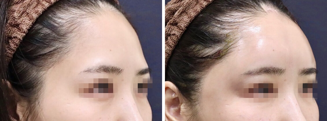 コンデンスリッチフェイスで三次元の立体的なオルチャンデコに