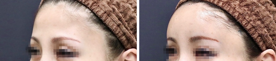 コンデンスリッチフェイスで丸くて可愛いオルチャンデコに