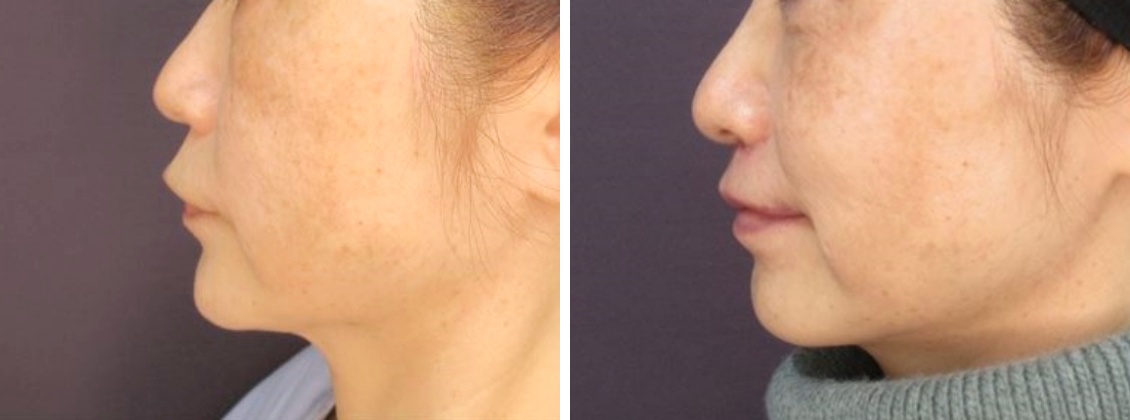 人中短縮術(リップリフト)・外側人中短縮術/口角挙上・リフト（マイクロ切開法・内側法/口内法）の症例写真 施術前後 1ヵ月後