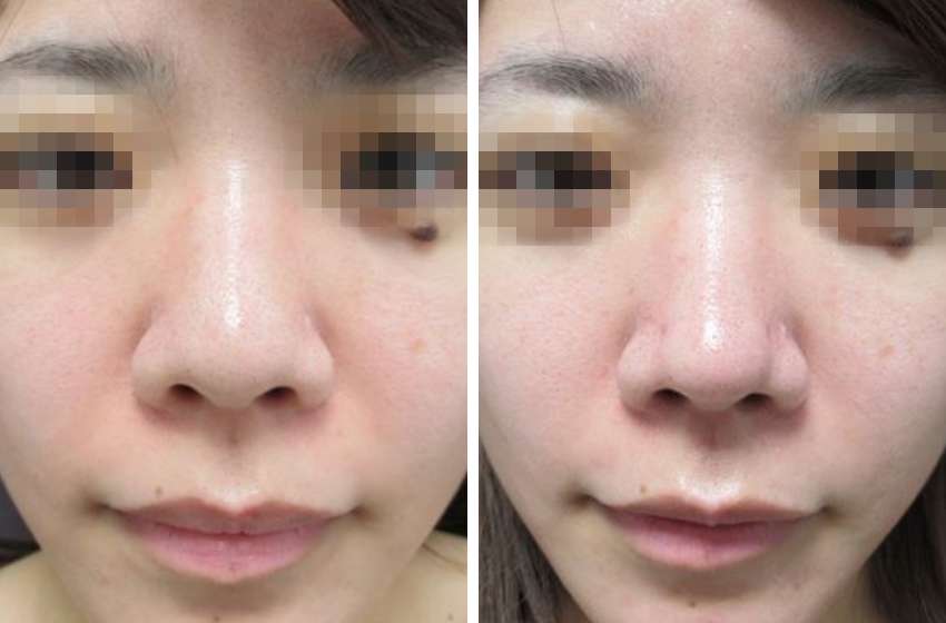 鼻尖4Dノーズ/鼻尖形成・鼻尖縮小の症例写真 施術前後 １ヵ月後