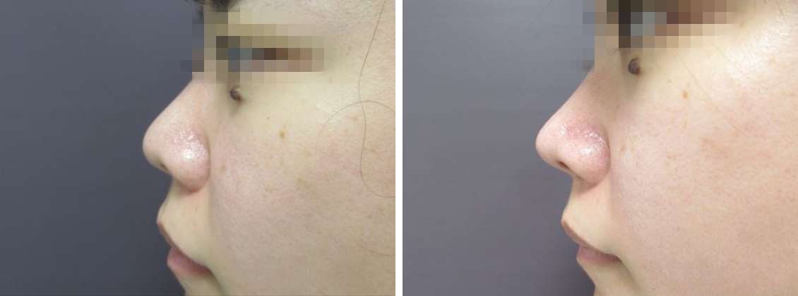 鼻尖縮小術と４Dノーズで自然にスッキリと