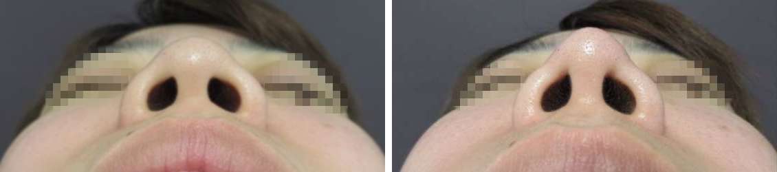 鼻尖4Dノーズ/鼻尖形成・鼻尖縮小の症例写真 施術前後 １ヵ月後