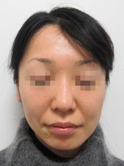 ツヤ肌コラーゲンリフトで美人度を上げる 症例写真 Taクリニック 美容整形 美容外科 新宿 銀座 大阪 福岡 高崎