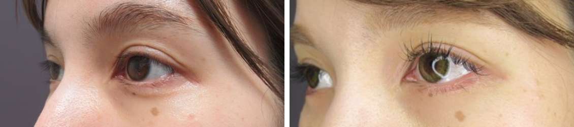 グラマラスライン（タレ目形成）の症例写真 施術前後 １ヵ月後