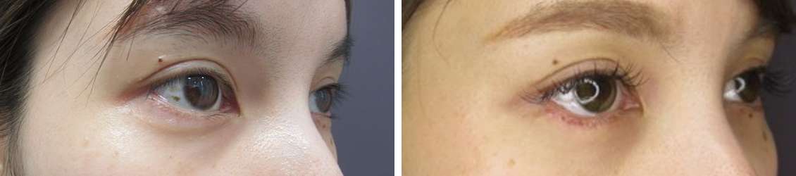 グラマラスライン（タレ目形成）の症例写真 施術前後 １ヵ月後