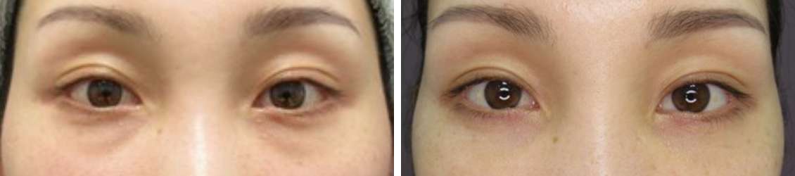 下眼瞼脱脂術で一気に目元若返り！