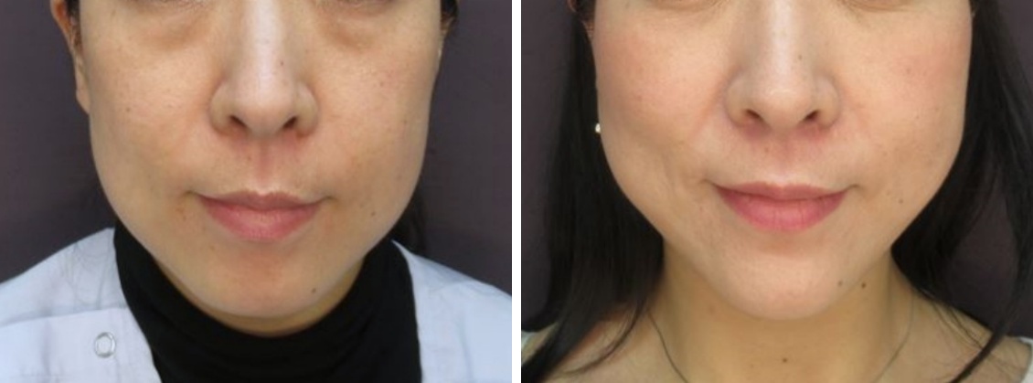 下眼瞼脱脂とツヤ肌コラーゲンリフトで自然な若返り