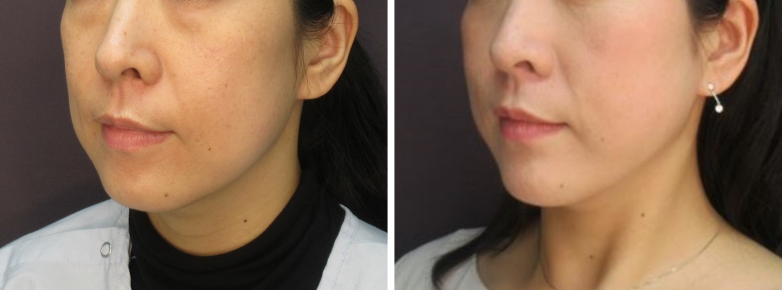 TAC式 ツヤ肌コラーゲンリフト®/下眼瞼脱脂術（目の下のたるみ取り・目の下の脂肪ふくらみ取り）/顎のヒアルロン酸注射の症例写真 施術前後 1ヵ月