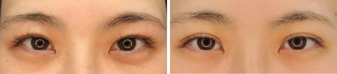 埋没法で自然な平行型二重へ