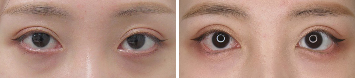 眼瞼下垂 目つき矯正 重たいまぶたを改善 眼瞼下垂手術の効果 費用 痛み 腫れや仕事復帰までの期間について Taクリニックグループ 美容整形 美容外科 全国展開中