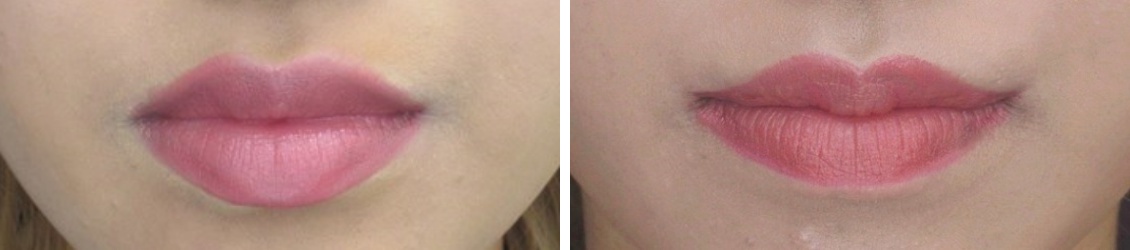 M字リップ形成術と口角挙上(口角リフト)でセクシーかつ可愛い最強リップ