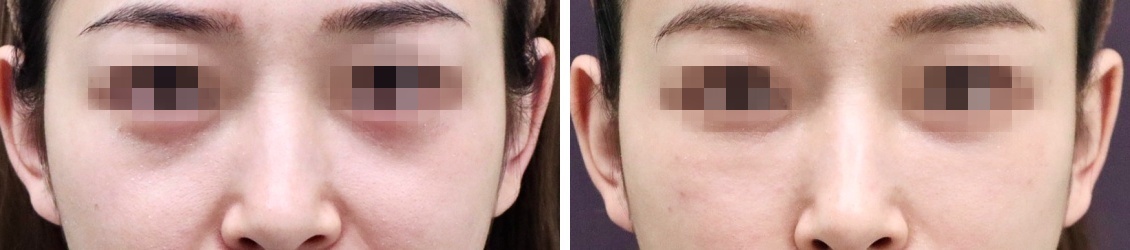 脂肪注入で若々しい目元へ