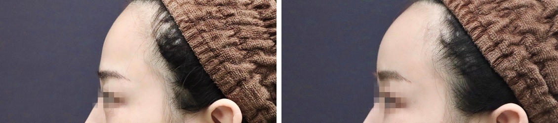 おでこの脂肪注入（オルチャンデコ形成）/顔の脂肪注入(コンデンスリッチフェイス)の症例写真 施術前後 1ヵ月