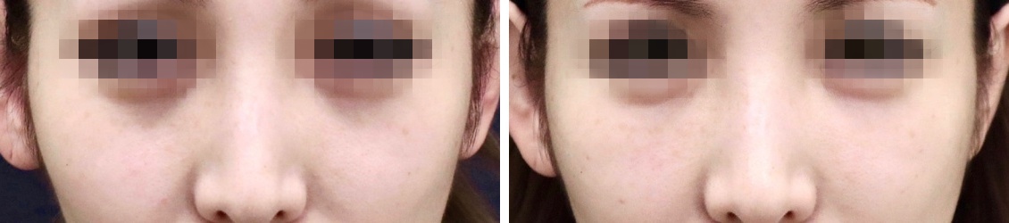 脂肪注入でお顔をより明るい印象に