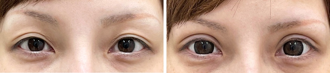 バレたくないならコスメリングプロカルテット