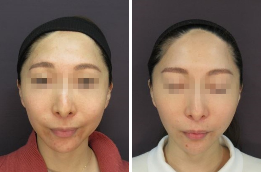 ツヤ肌コラーゲンリフトとエラボトックス+1dayスリムフェイスで卵型フェイスに