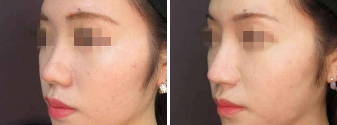 鼻尖縮小術、鼻尖４Dノーズ、鼻翼縮小術、鼻孔縁挙上術で美しい鼻に