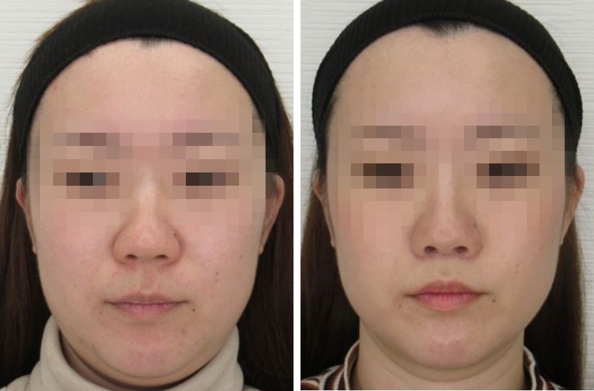 人中とアゴ下の黄金比は1:2