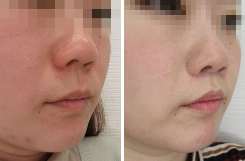 人中短縮術(リップリフト)・外側人中短縮術の症例写真 施術前後 1ヵ月後