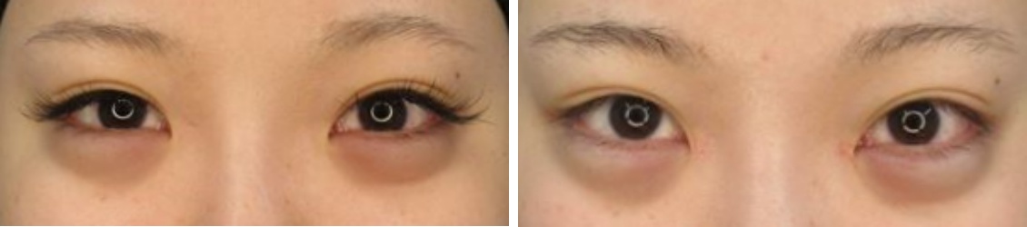 目頭切開術でパッチリ目元へ