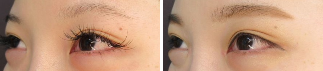 目頭切開術の症例写真 施術前後 1ヵ月後