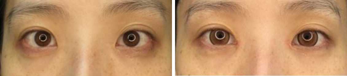 目頭切開術の症例写真 施術前後 1ヵ月後