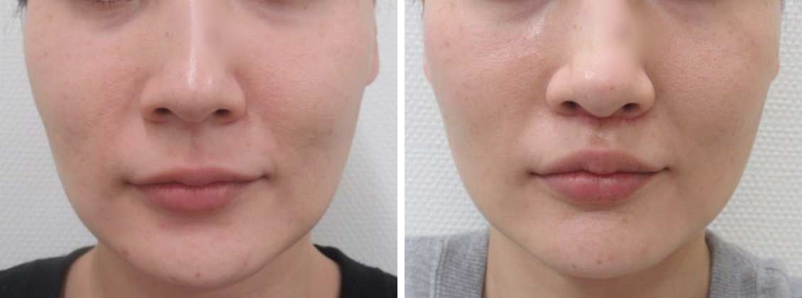 人中短縮でより若々しく