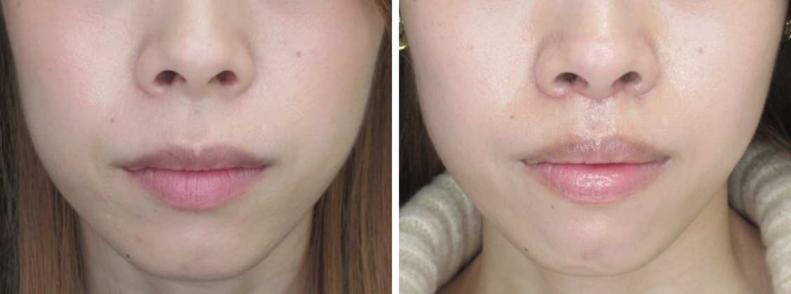 人中短縮術で自信のある口元へ