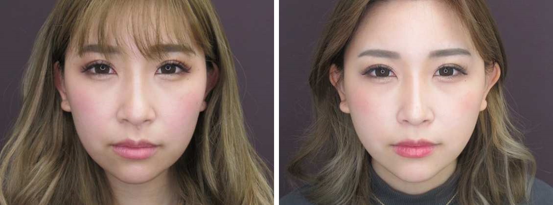 ツヤ肌コラーゲンリフトで卵型の輪郭形成