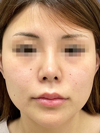 ツヤ肌コラーゲンリフトで憧れのv字フェイス 症例写真 Taクリニック 美容整形 美容外科 新宿 銀座 大阪 福岡 高崎