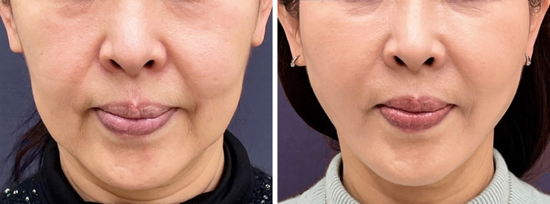 ツヤ肌コラーゲンリフトとヒアルロン酸で若返る