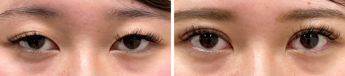 コスメリングで生まれつきのような二重へ