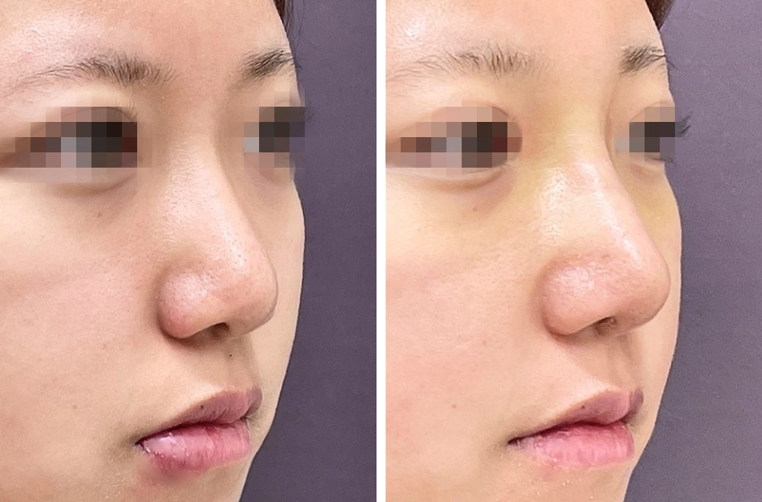 4Dノーズ・鼻尖縮小術・隆鼻術プロテーゼでお鼻を整え美人度アップ！