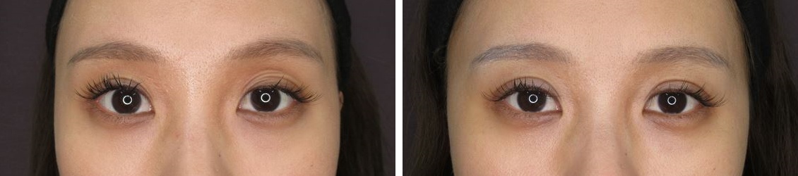 1dayナチュラルデザインオプティマルで綺麗な二重に