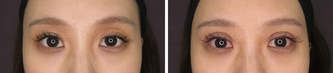 二重埋没法の症例写真 施術前後 直後